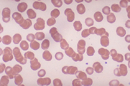 viral-bad-dead-blood-cells-acidic